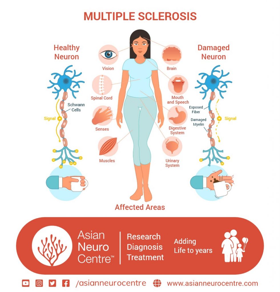 Symptoms of Multiple Sclerosis - Best Neurologist Indore | Dr. Navin Tiwari