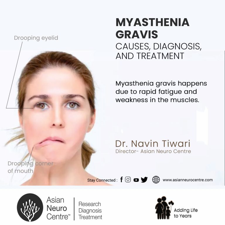 Myasthenia Gravis Causes, Diagnosis & Treatment, asianneurocentre.com