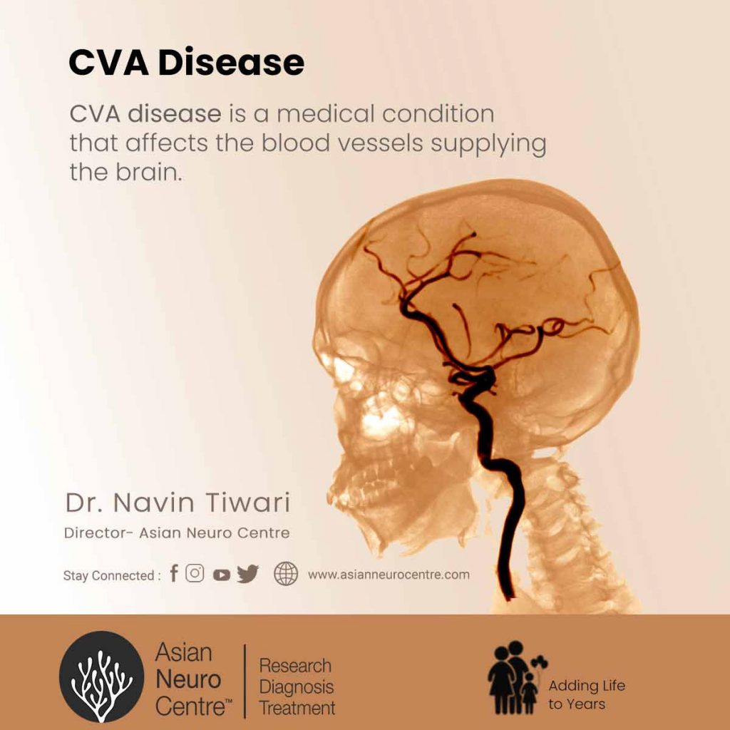 Cerebrovascular Accident Cva Is Also Known As