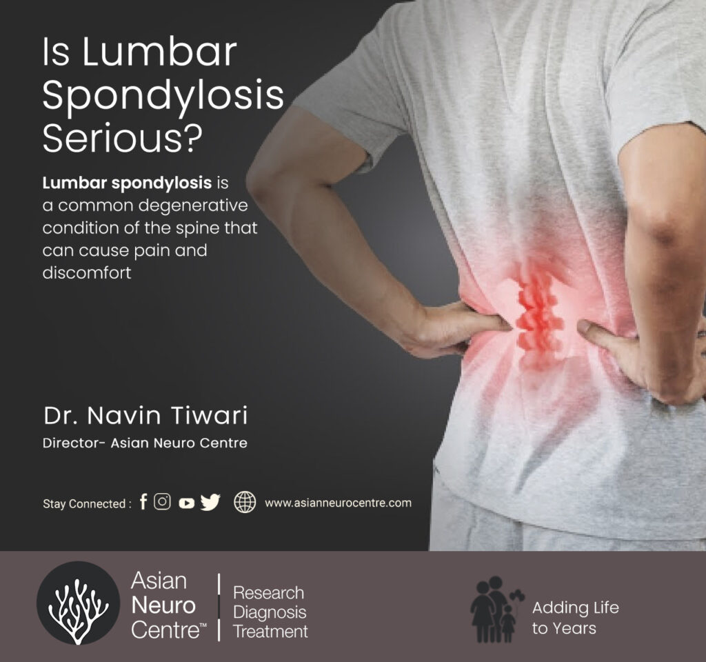 Is Lumbar Spondylosis Serious