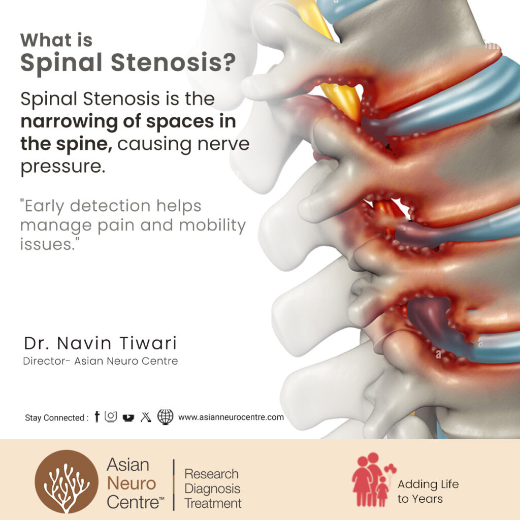 What is Spinal Stenosis?, Symptoms, Causes, Treatment